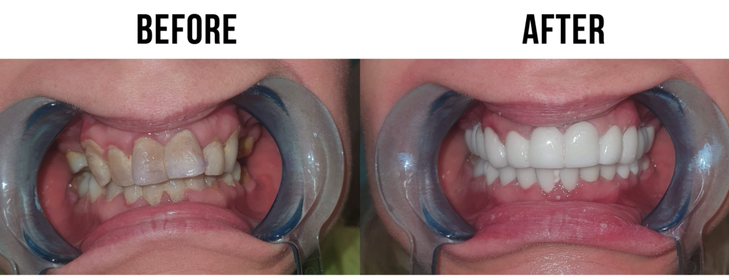 before-after-1