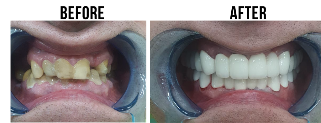 before-after-5