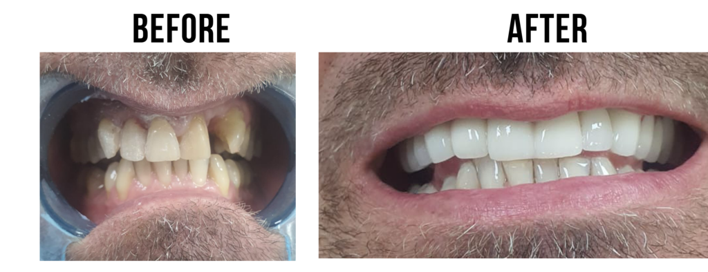 before-after-6