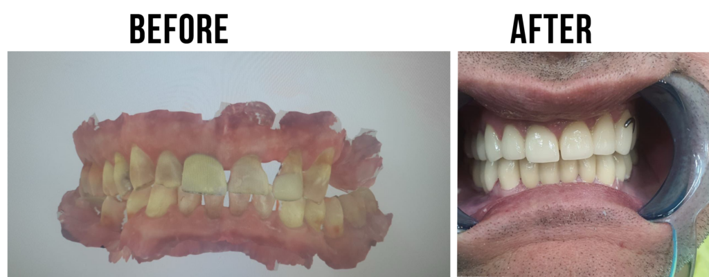 before-after-30