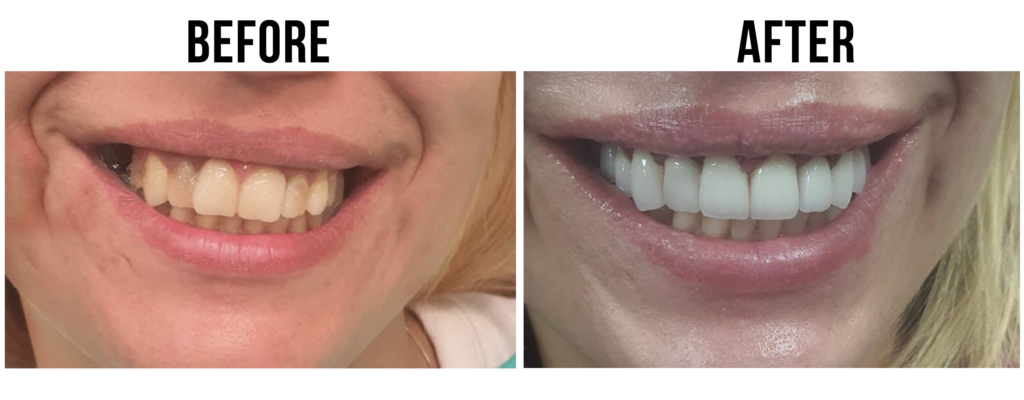 before-after-33